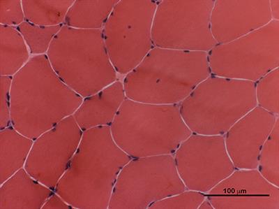 Flecainide-Induced Brugada Syndrome in a Patient With Skeletal Muscle Sodium Channelopathy: A Case Report With Critical Therapeutical Implications and Review of the Literature